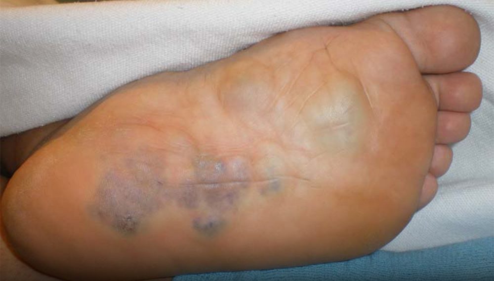 Missed arteriovenous malformation in the foot