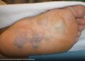 Missed arteriovenous malformation in the foot