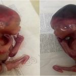 Figure 4: Side views of foetus with Sirenomelia demonstrating posteriorly facing feet